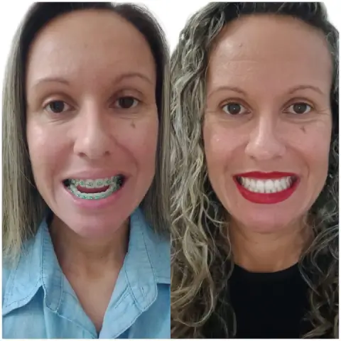 Cirurgia Ortognática antes e depois dra fernanda pirossi