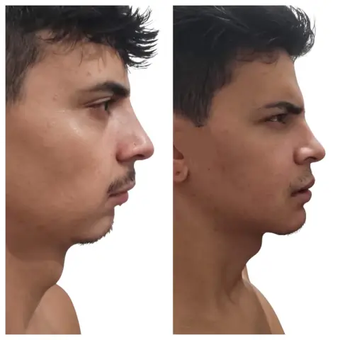 Cirurgia Ortognática perfil dra fernanda pirossi