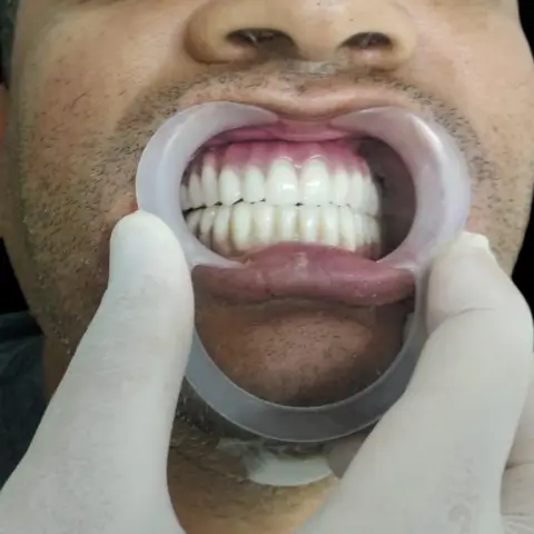 Cirurgia de implantes odontológico fernanda pirossi