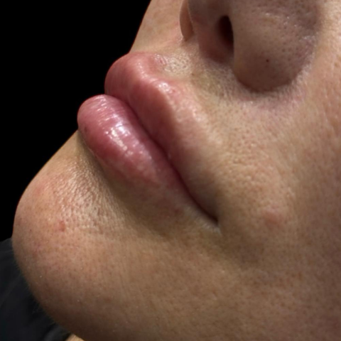 preenchedor-de-labios